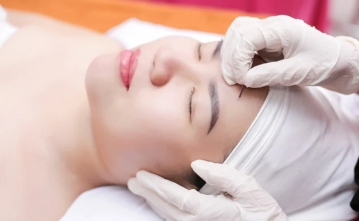 Lấy nhân mụn bằng tăm bông chuẩn y khoa có tốt không?